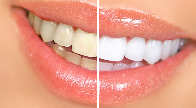 7 tipp a fehérebb fogakért – orvos nélkül