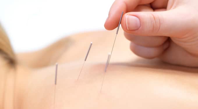 Akupunktúra- felhasználás prosztatitis
