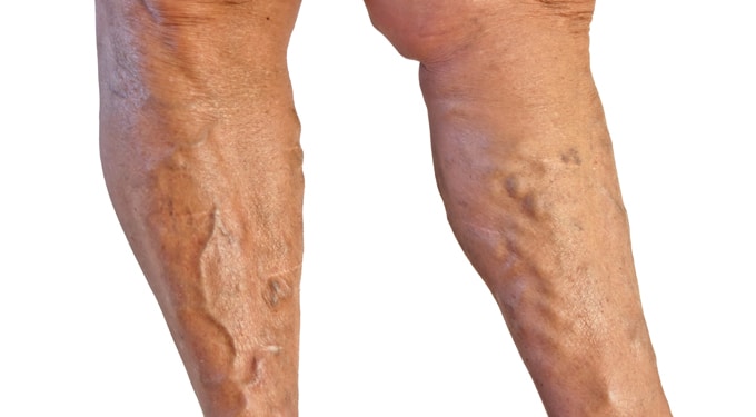 Mit kell tenni, ha a lábad visszeres, Visszérbetegség tünetei és kezelése - HáziPatika