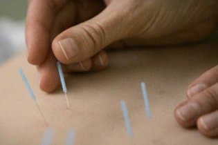 Az akupunktúra segít leszokni a dohányzásról