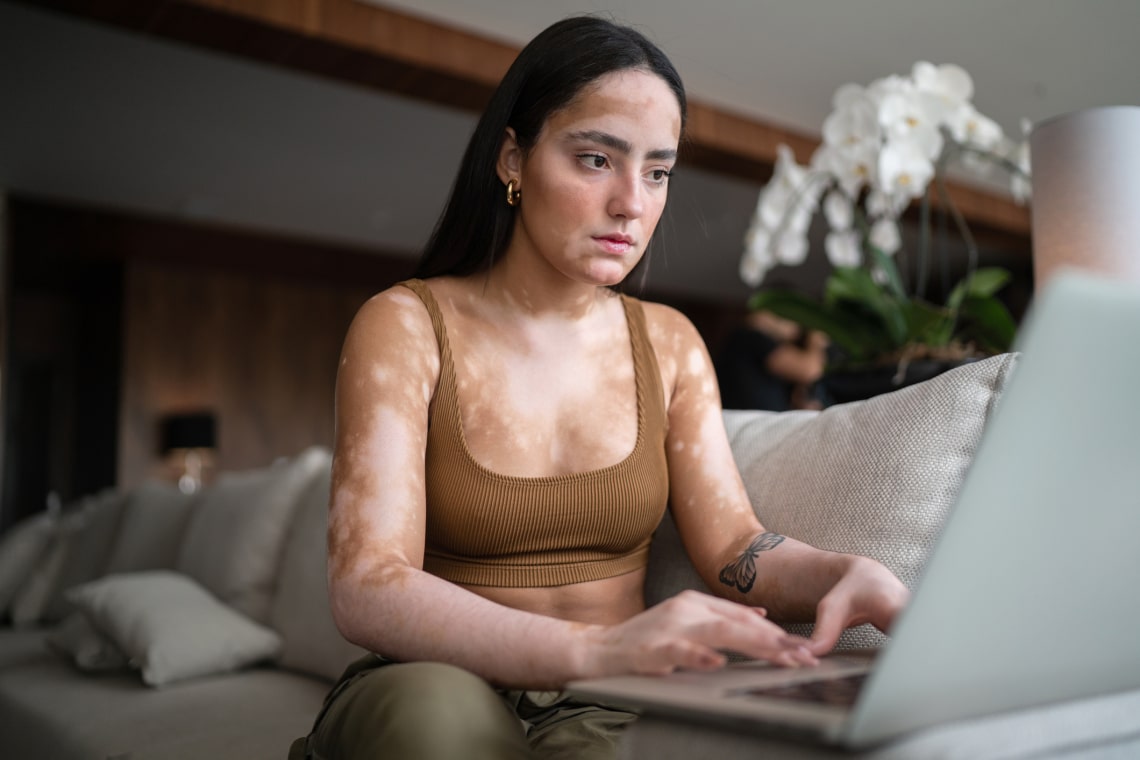 Fehér foltos bőr, avagy vitiligo: a különleges bőrelváltozás bárkinél felbukkanhat