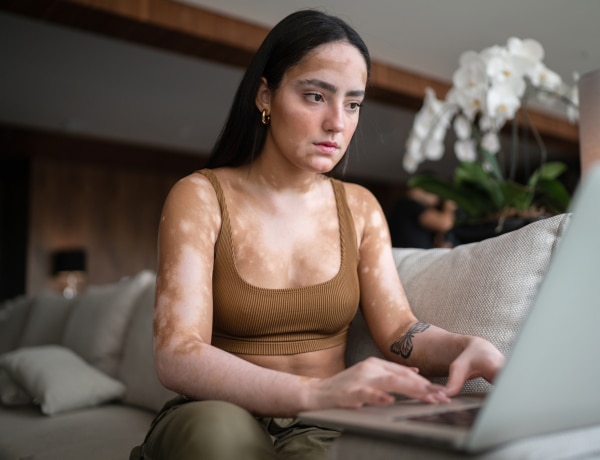 Fehér foltos bőr, avagy vitiligo: a különleges bőrelváltozás bárkinél felbukkanhat