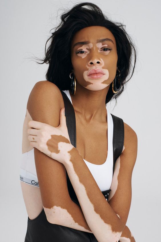 Winnie Harlow