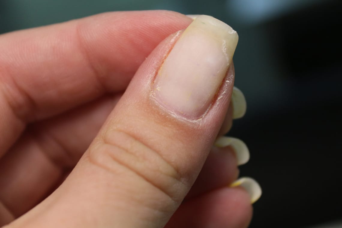 Sárgás elszíneződés