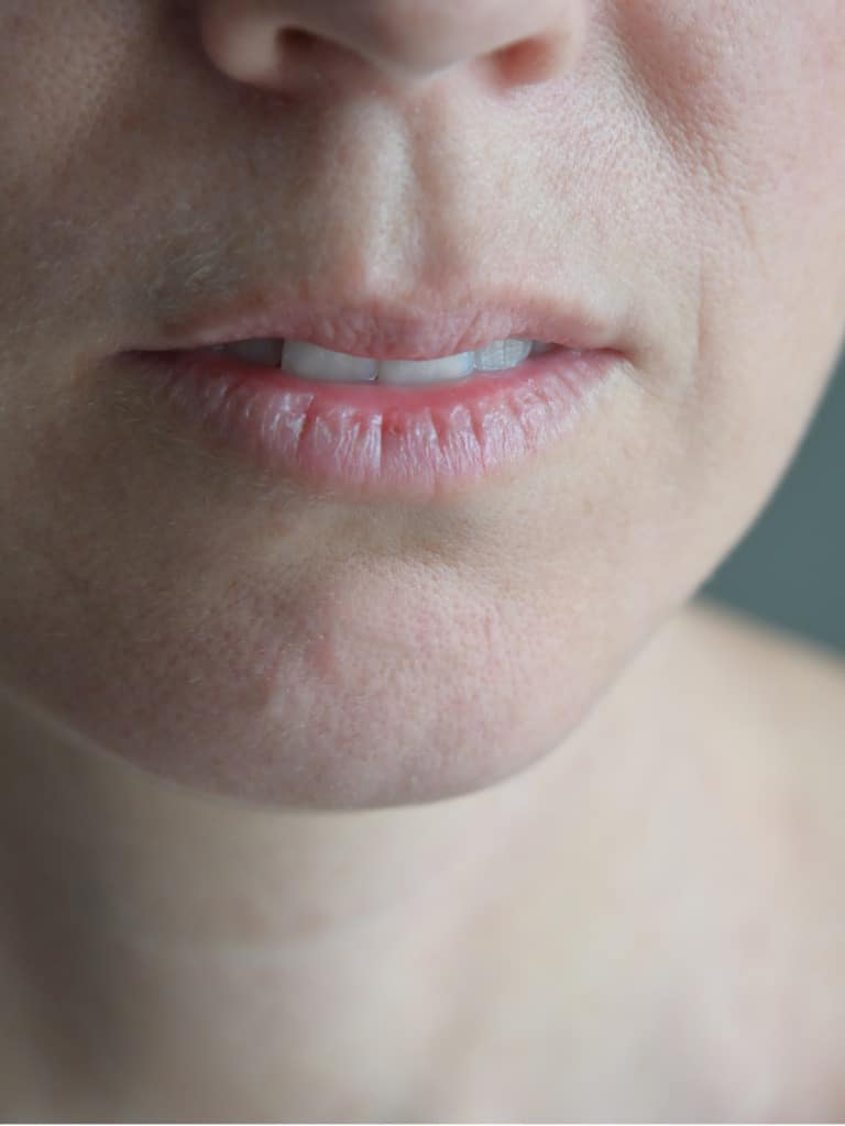 Száraz/repedezett ajkak