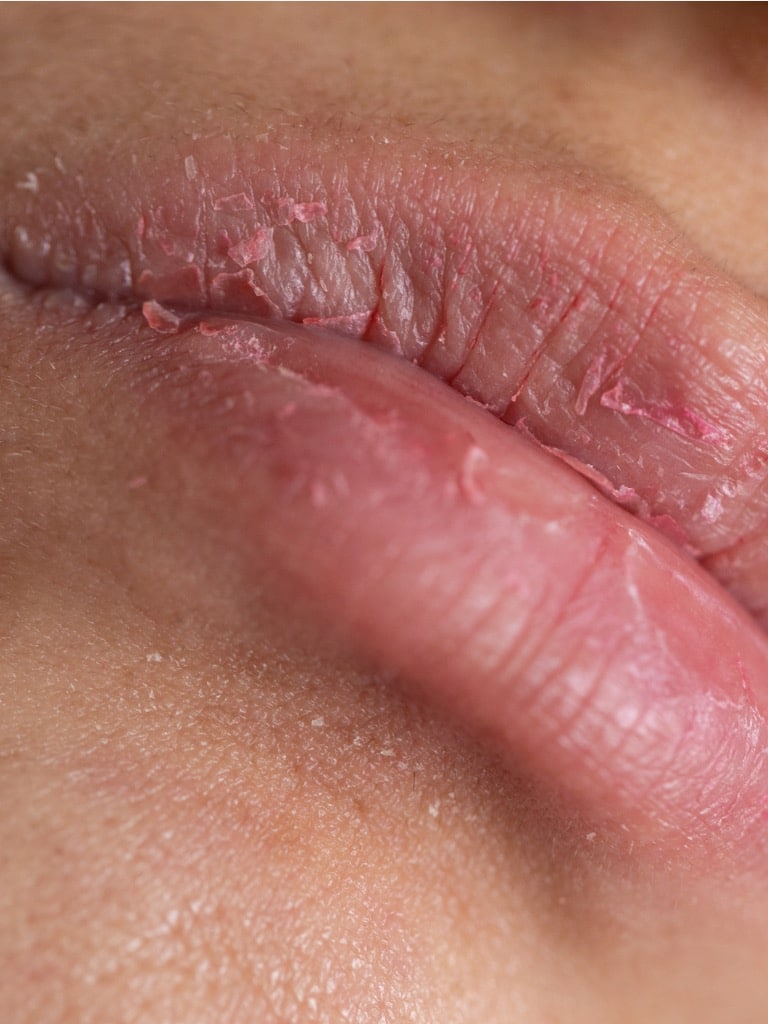 Repedezett vagy hámló ajkak