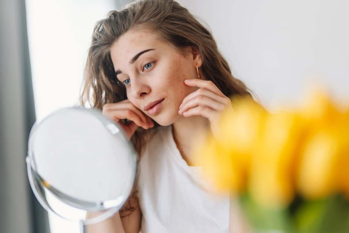 Így halványítsd vagy tüntesd el a bárányhimlő nyomait