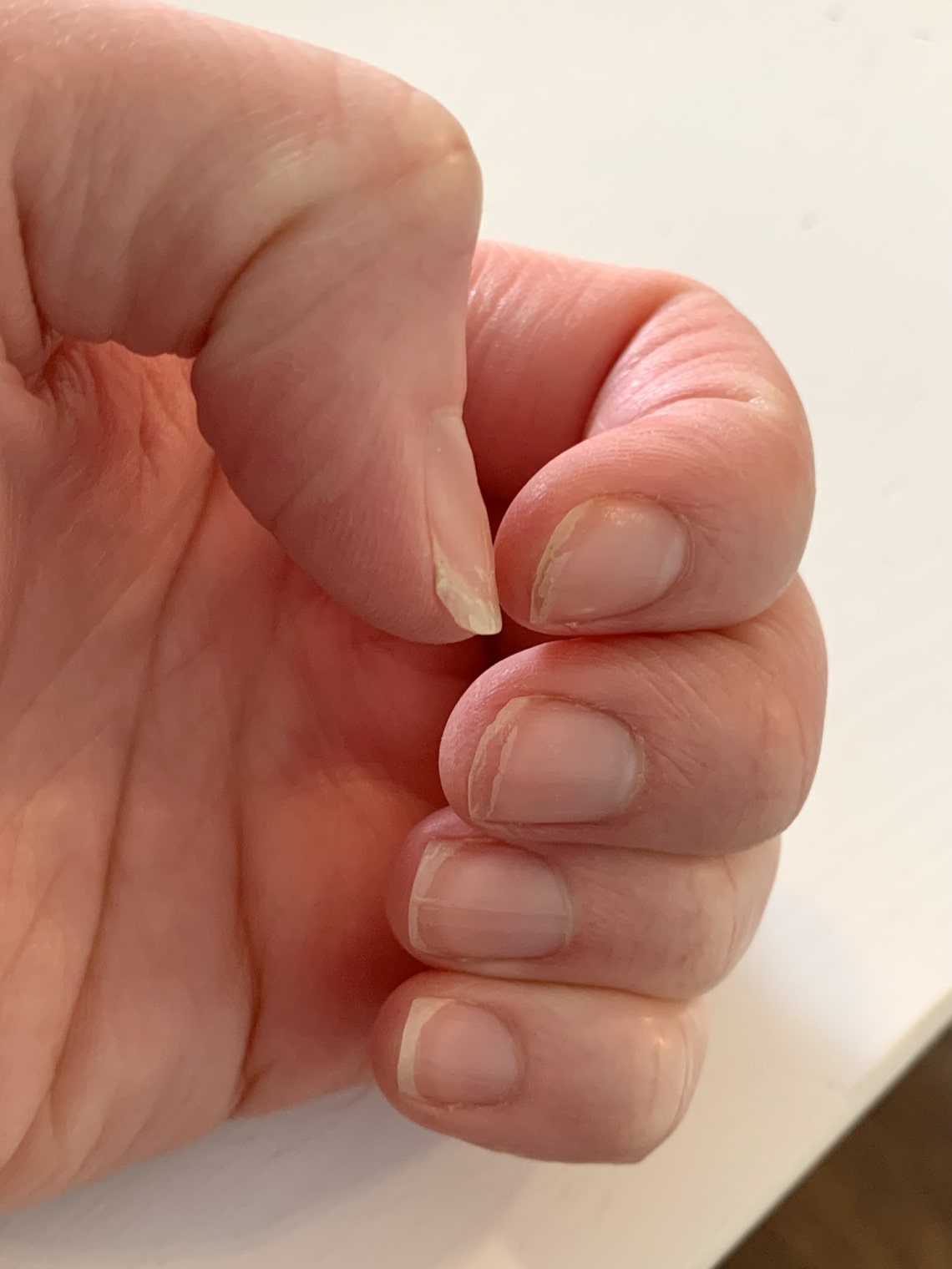 Milyen kockázatokkal jár a körömrágás?