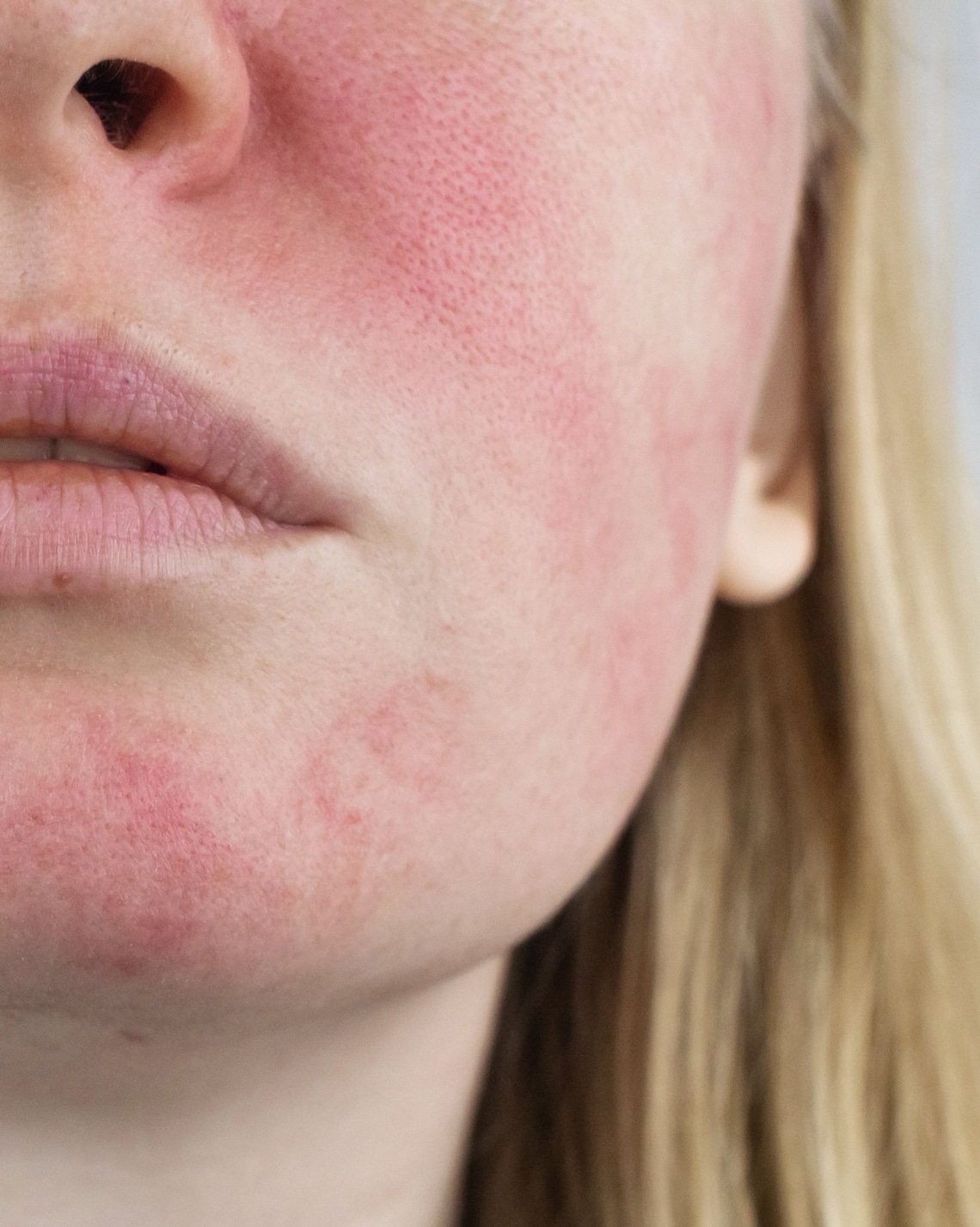 Rosacea