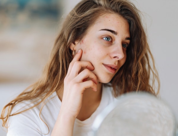 Melyik bőrhiba utalhat hormonális problémára? Segítünk megfejteni!