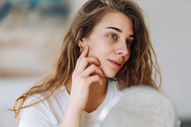 Melyik bőrhiba utalhat hormonális problémára? Segítünk megfejteni!