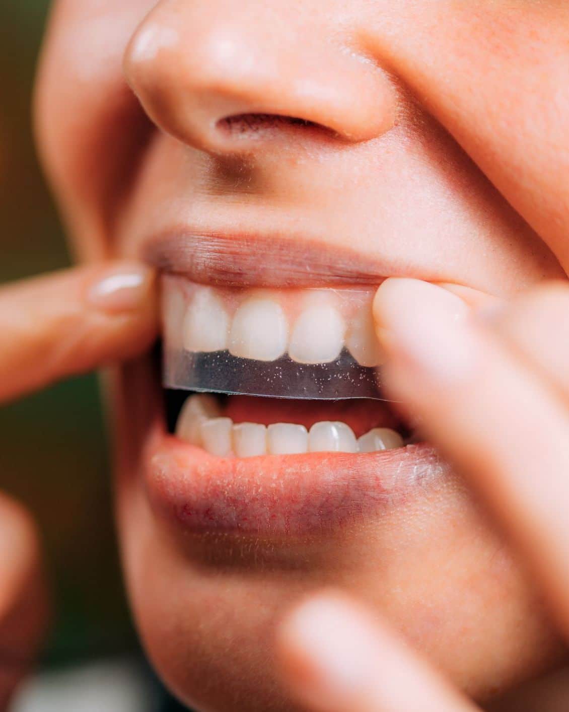 Fogfehérítő matrica