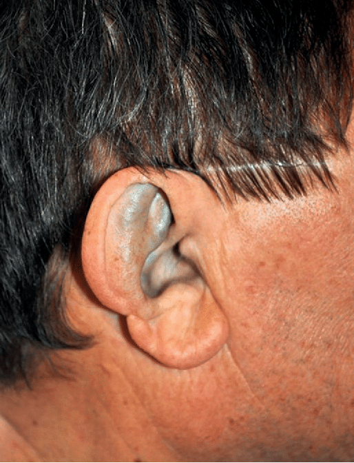 Fekete vizelet szindróma