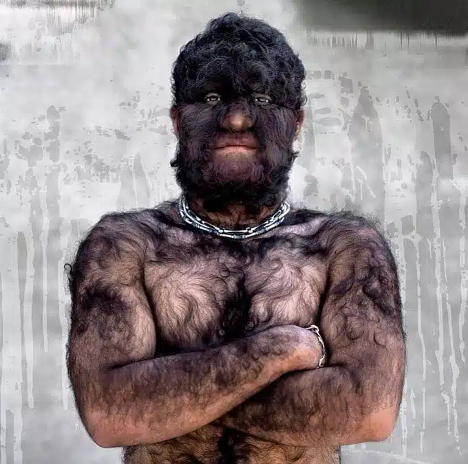 Farkasember szindróma