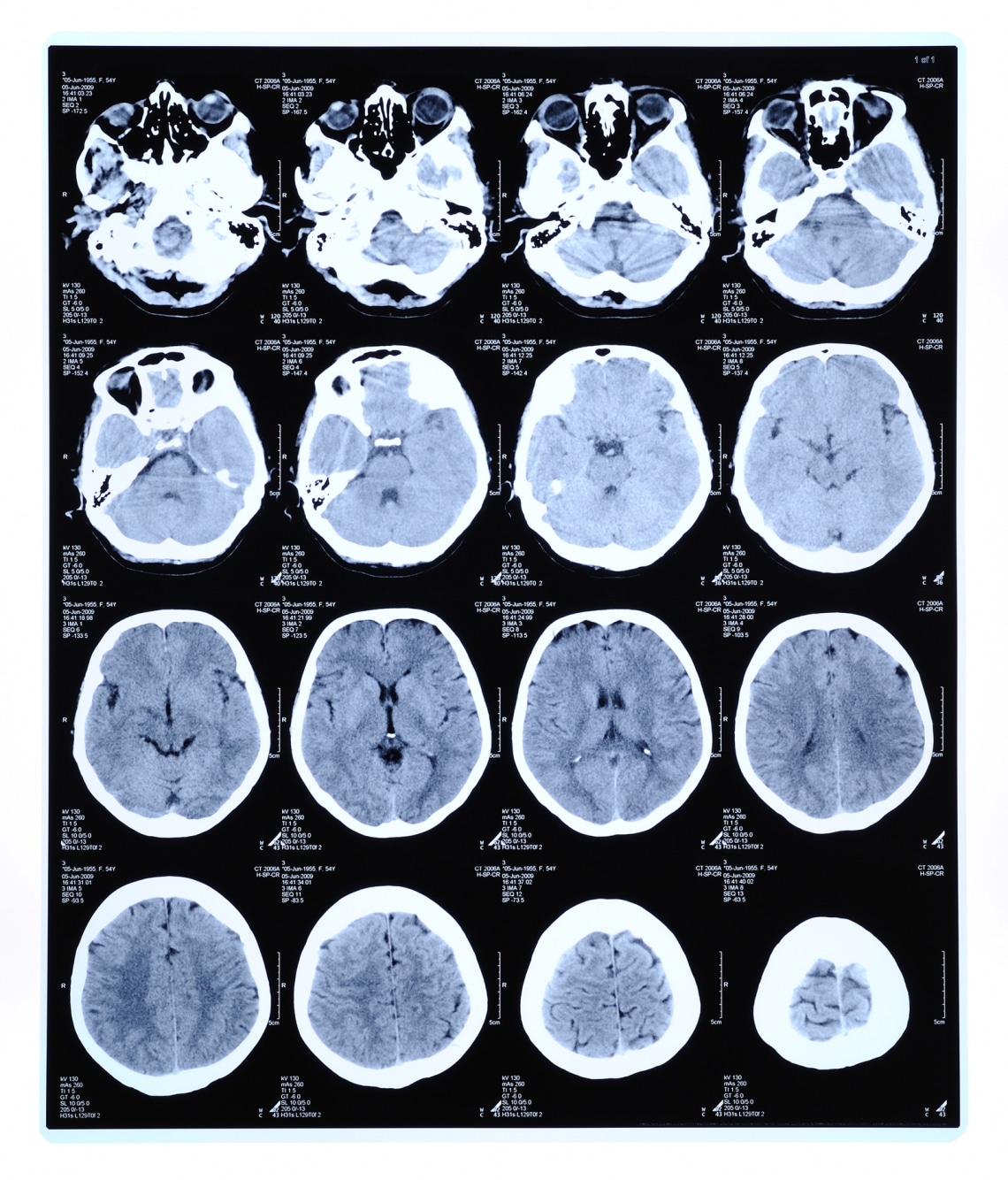 Daganatos elváltozások