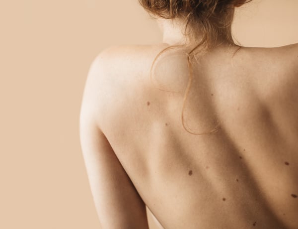 Jelek, hogy baj van az anyajegyeddel – a bőrgyógyász válaszol