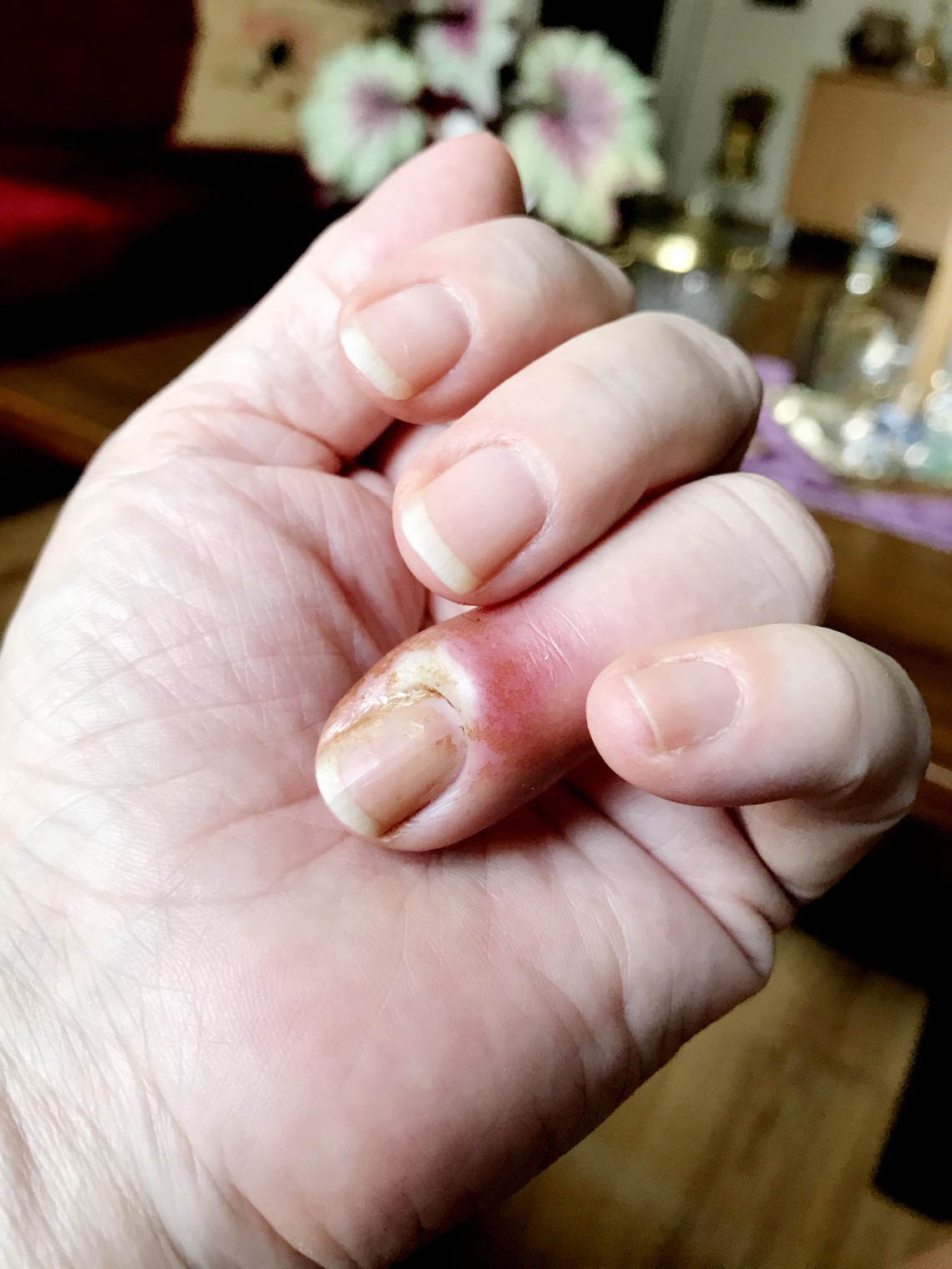 Körömágygyulladás