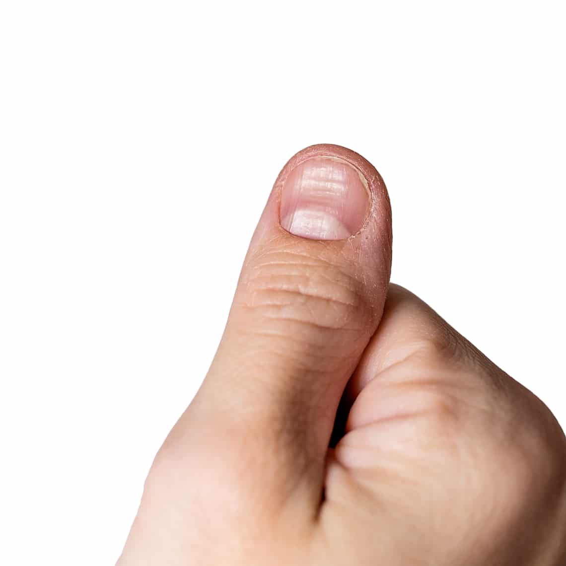 Kanálszerű körmök