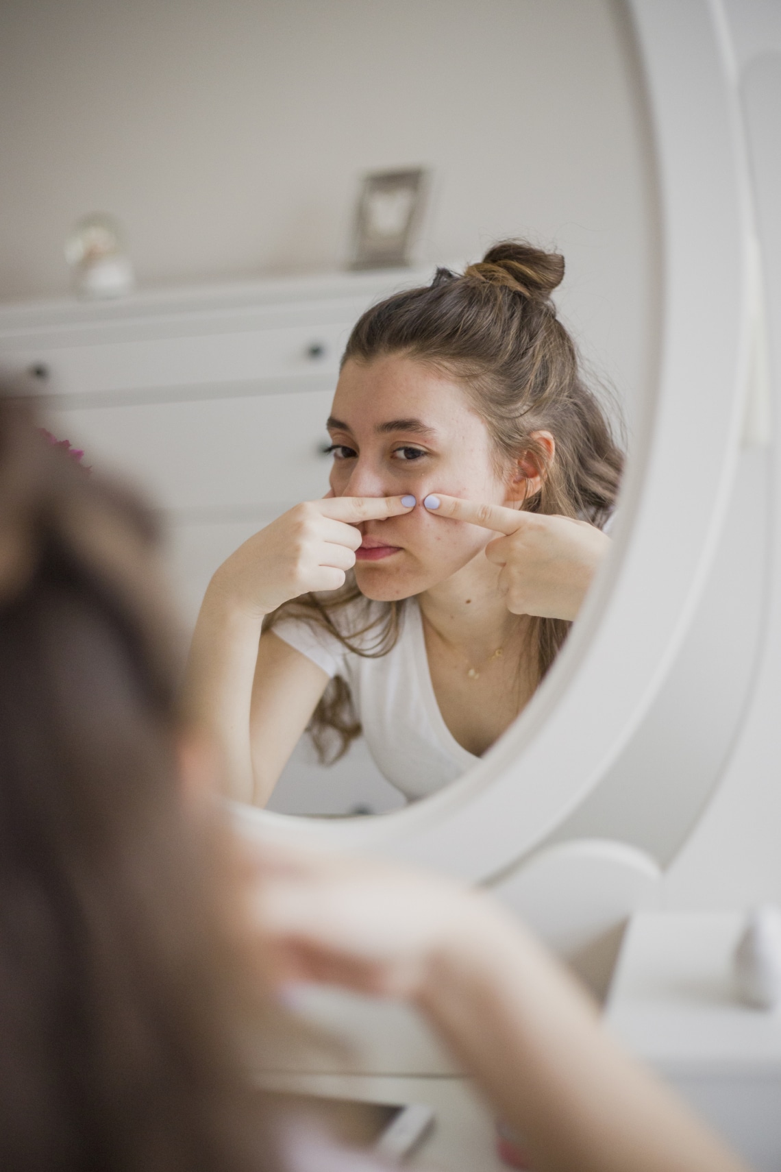 Pattanásos lehet a bőröd