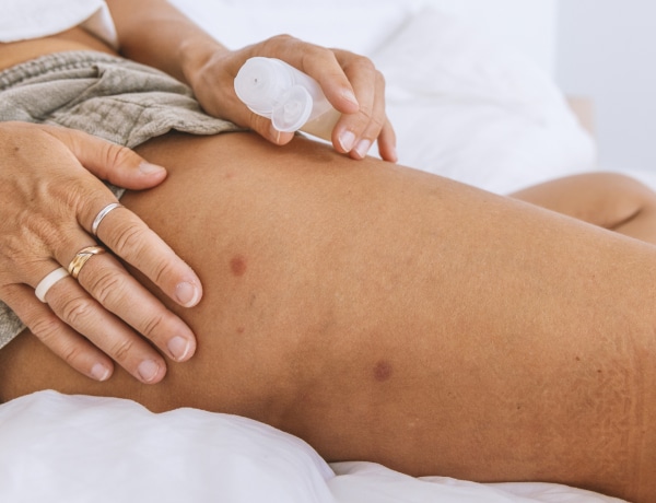 Amikor komolyan kell venned: aggasztó tünetek szúnyogcsípés után 