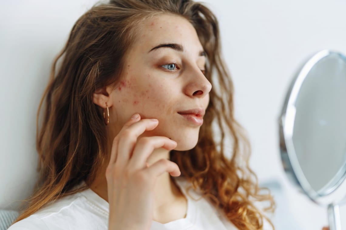 Erről árulkodhatnak az arcodon megjelenő aknék és pattanások