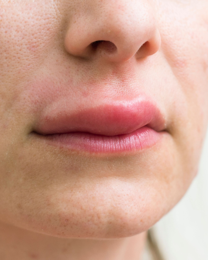 Allergiás reakciók kozmetikumoktól