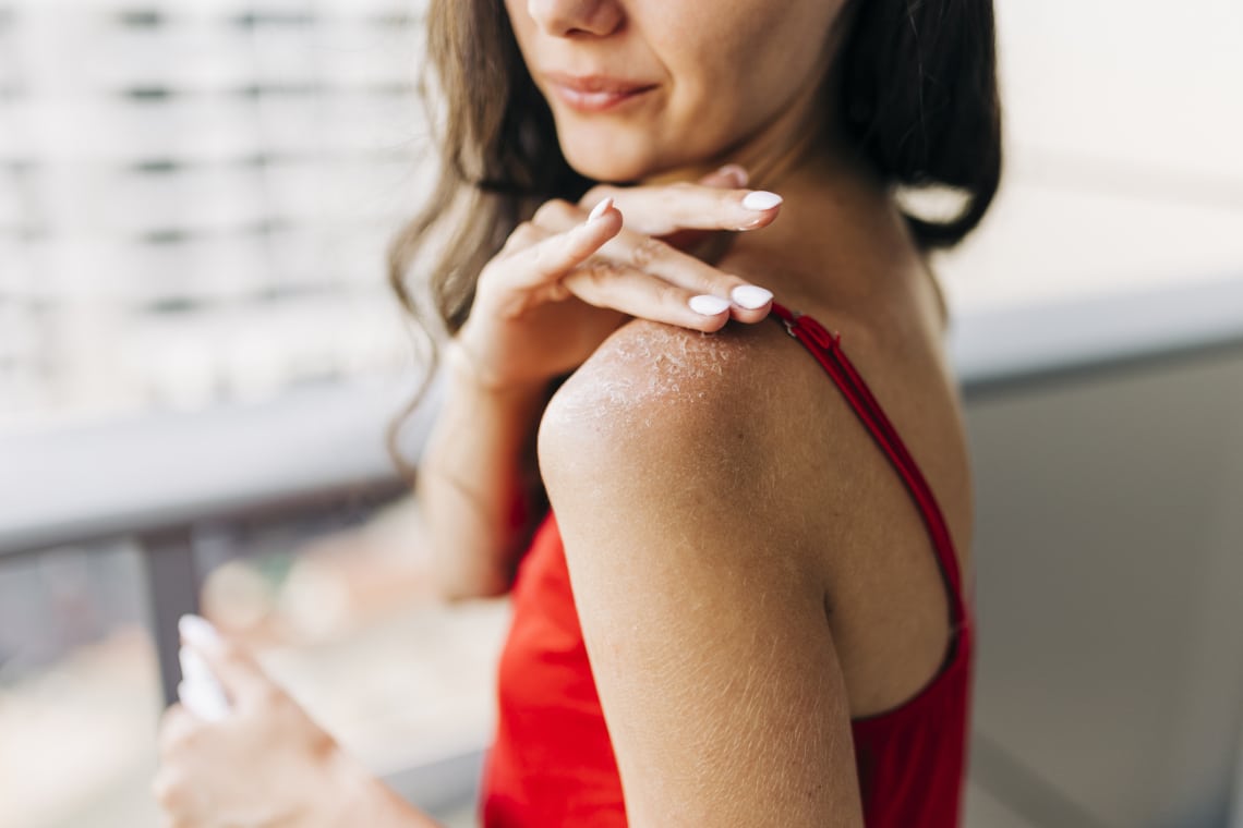 5 természetes SOS megoldás napégésre