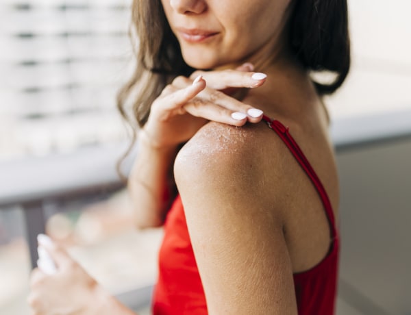 5 természetes SOS megoldás napégésre