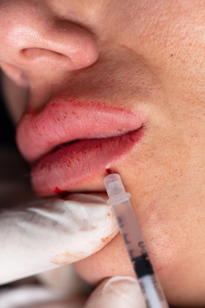 Nő ajkát hialuronsavval töltik