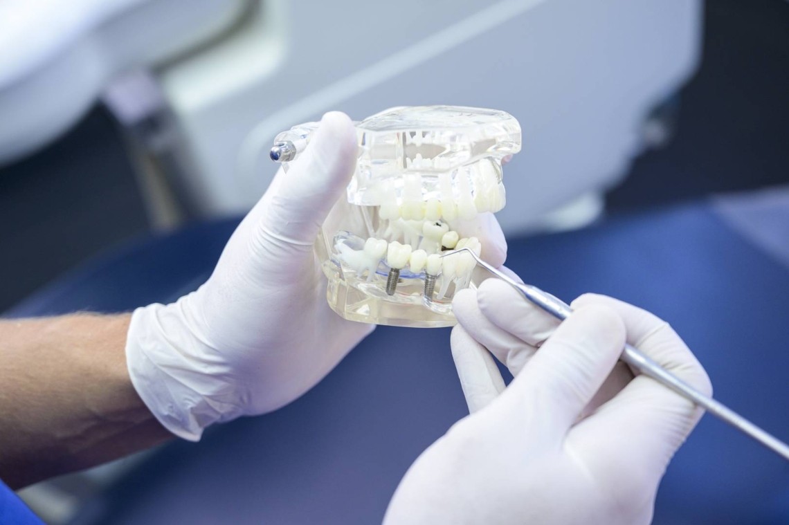 Teljes fogsor implantátum – mindig ez a legjobb megoldás?