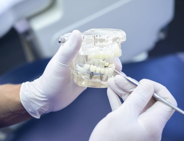 Teljes fogsor implantátum – mindig ez a legjobb megoldás?