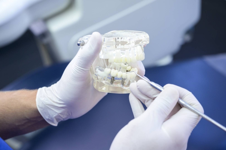 Teljes fogsor implantátum – mindig ez a legjobb megoldás?