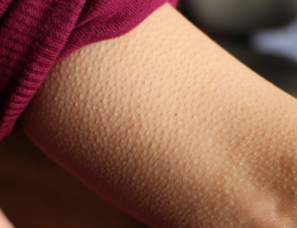 Miért csuklunk, és miért leszünk libabőrösek? Ősi reflexek állnak a háttérben