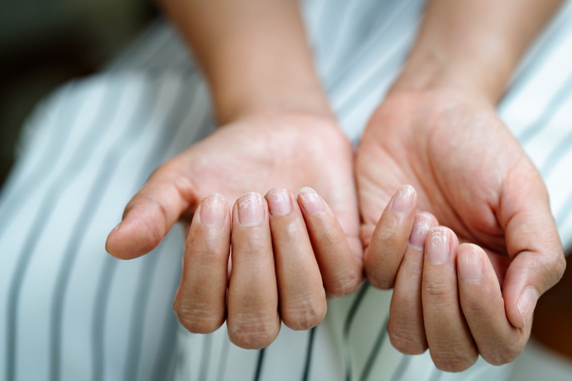 5 jel a körmödön, ami nem vitaminhiányra, hanem komoly pajzsmirigy-problémára figyelmeztet